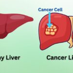 Liver Cancer 2025