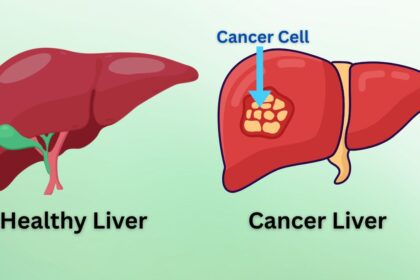 Liver Cancer 2025