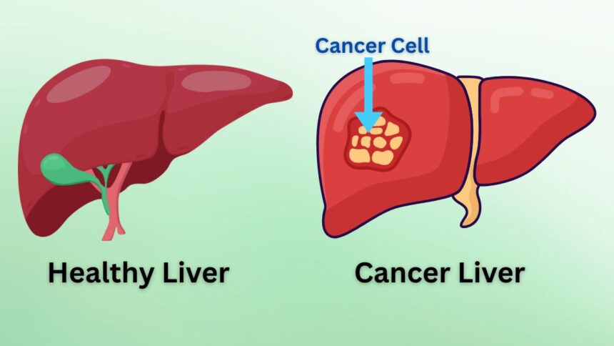 Liver Cancer 2025