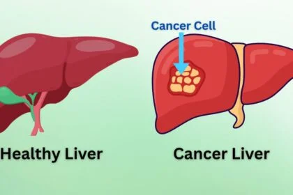 Liver Cancer 2025